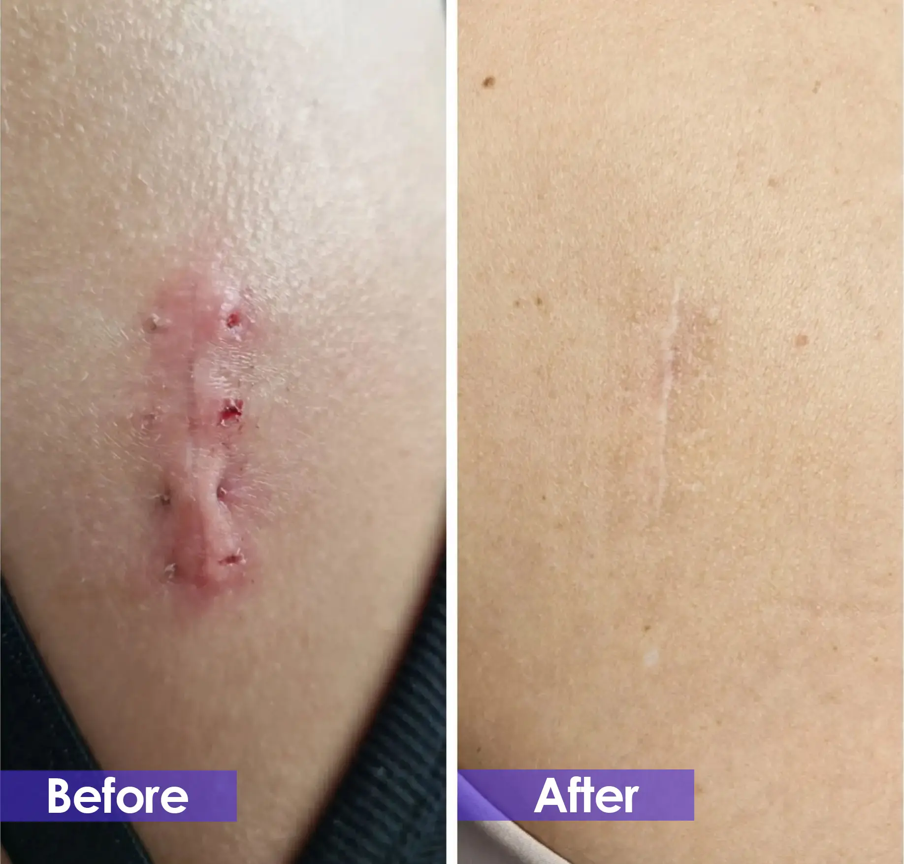 laser scar removal cost